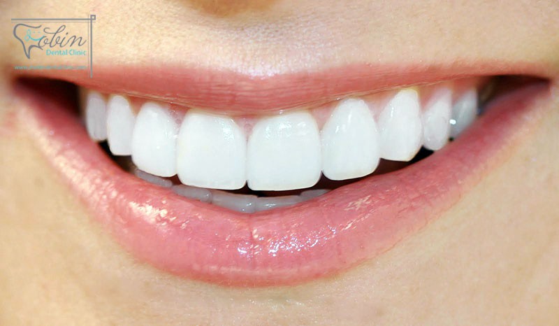 لمینت دندان چه کاربردی دارد؟